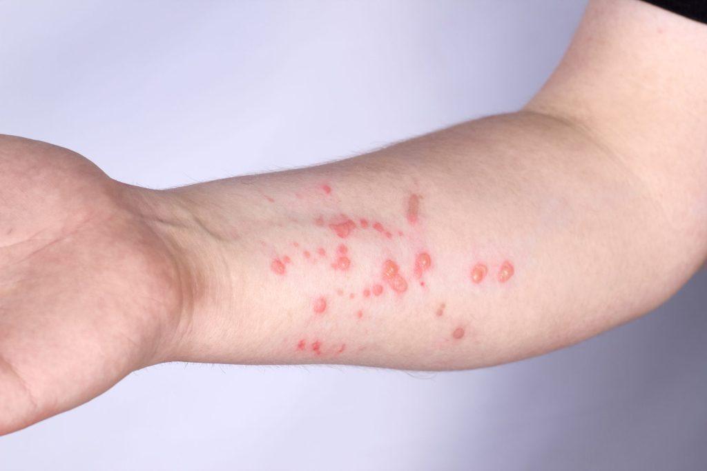 SANITA’ – Il primo caso di “monkeypox” scoperto in Polonia